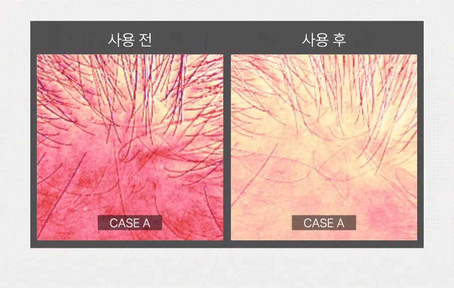 [탄산버블/두피쿨링] 하아르 닥터두피톡스 100ml 상세페이지 18